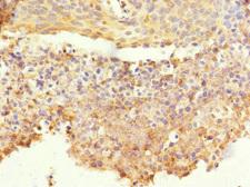 CORO1C Antibody - Immunohistochemistry of paraffin-embedded human cervical cancer at dilution 1:100
