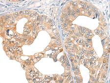 CORO2A Antibody - Immunohistochemistry of paraffin-embedded Human gastric cancer tissue  using CORO2A Polyclonal Antibody at dilution of 1:45(×200)