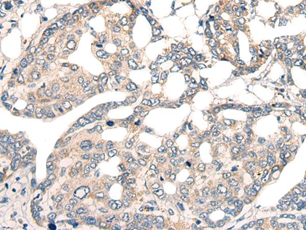 CORO2A Antibody - Immunohistochemistry of paraffin-embedded Human liver cancer tissue  using CORO2A Polyclonal Antibody at dilution of 1:45(×200)