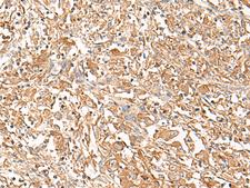 CORO2A Antibody - Immunohistochemistry of paraffin-embedded Human liver cancer tissue  using CORO2A Polyclonal Antibody at dilution of 1:50(×200)