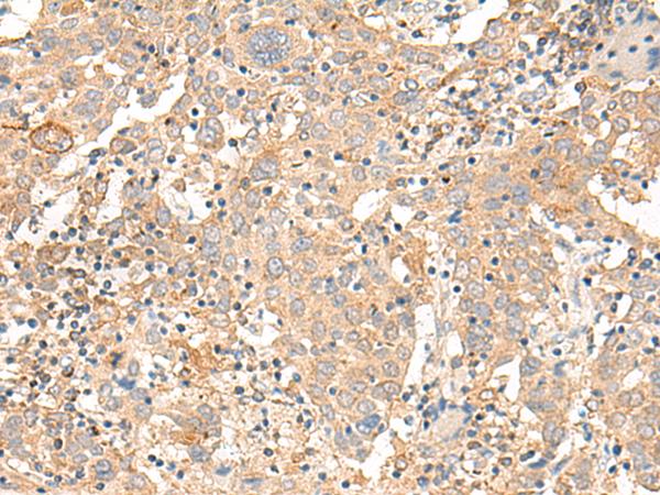 CORO2A Antibody - Immunohistochemistry of paraffin-embedded Human cervical cancer tissue  using CORO2A Polyclonal Antibody at dilution of 1:30(×200)