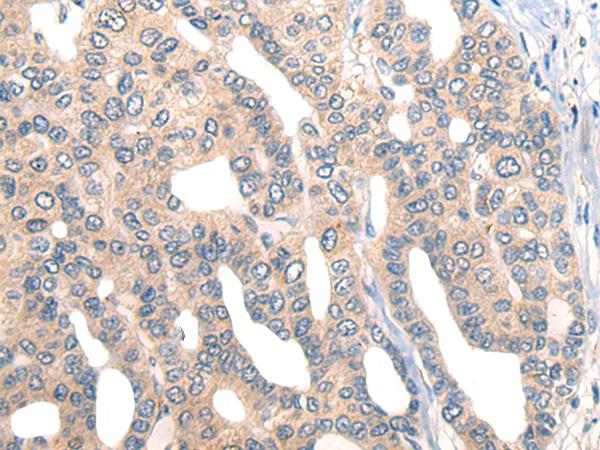 CORO2B Antibody - Immunohistochemistry of paraffin-embedded Human liver cancer tissue  using CORO2B Polyclonal Antibody at dilution of 1:50(×200)