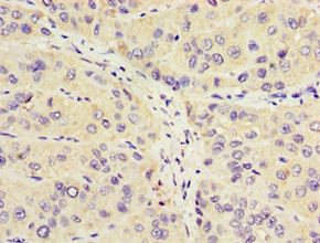 COT / CROT Antibody - Immunohistochemistry of paraffin-embedded human liver cancer gland using antibody at 1:100 dilution.