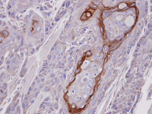 COT / CROT Antibody - IHC of paraffin-embedded Ca922 xenograft using CROT antibody at 1:100 dilution.