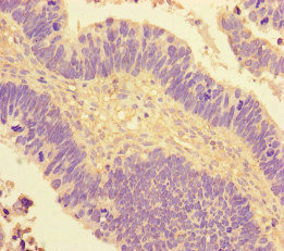 COUP-TFII / NR2F2 Antibody - Immunohistochemistry of paraffin-embedded human ovarian cancer at dilution of 1:100