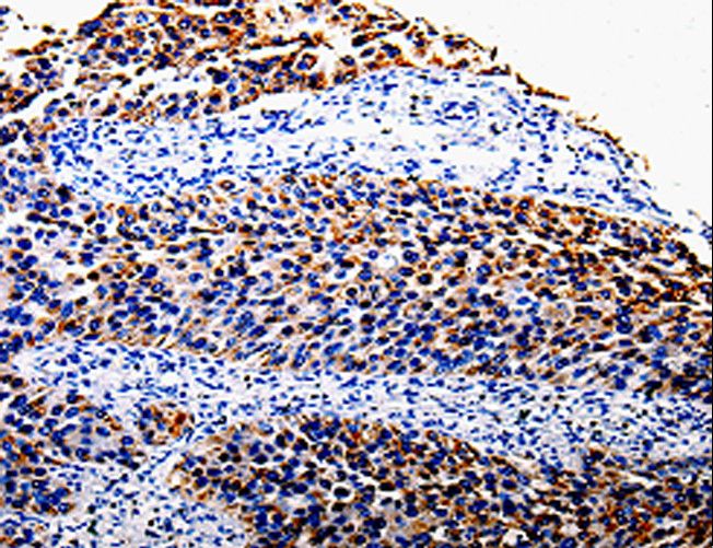 COX10 Antibody - Immunohistochemistry of paraffin-embedded Human renal cancer using COX10 Polyclonal Antibody at dilution of 1:100.