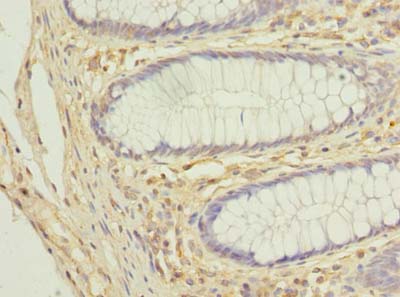 COX11 Antibody - Immunohistochemistry of paraffin-embedded human colon cancer using antibody at dilution of 1:100.