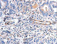 COX11 Antibody - Immunohistochemistry of paraffin-embedded Human stomach cancer using COX11 Polyclonal Antibody at dilution of 1:30.