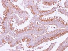 COX15 Antibody - IHC of paraffin-embedded Colon ca, using COX15 antibody at 1:250 dilution.
