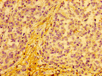 COX15 Antibody - Immunohistochemistry image at a dilution of 1:100 and staining in paraffin-embedded human colon cancer performed on a Leica BondTM system. After dewaxing and hydration, antigen retrieval was mediated by high pressure in a citrate buffer (pH 6.0) . Section was blocked with 10% normal goat serum 30min at RT. Then primary antibody (1% BSA) was incubated at 4 °C overnight. The primary is detected by a biotinylated secondary antibody and visualized using an HRP conjugated SP system.