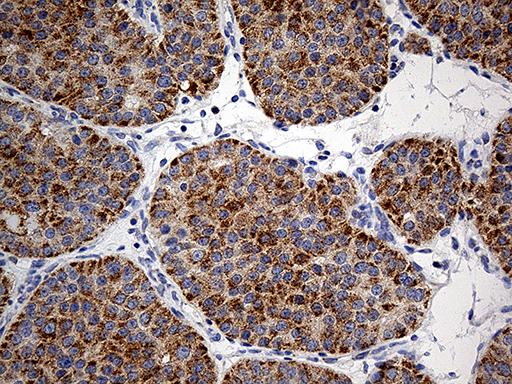 COX17 Antibody - Immunohistochemical staining of paraffin-embedded Carcinoma of Human pancreas tissue using anti-COX17 mouse monoclonal antibody. (Heat-induced epitope retrieval by 1mM EDTA in 10mM Tris buffer. (pH8.5) at 120°C for 3 min. (1:500)