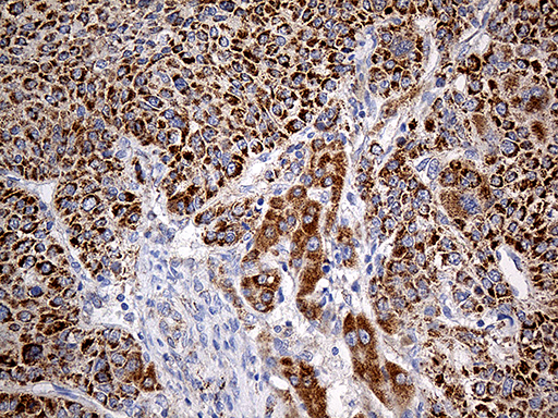 COX17 Antibody - Immunohistochemical staining of paraffin-embedded Carcinoma of Human liver tissue using anti-COX17 mouse monoclonal antibody. (Heat-induced epitope retrieval by 1mM EDTA in 10mM Tris buffer. (pH8.5) at 120°C for 3 min. (1:500)
