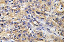COX17 Antibody - IHC of COX17 (N8) pAb in paraffin-embedded human liver carcinoma tissue.