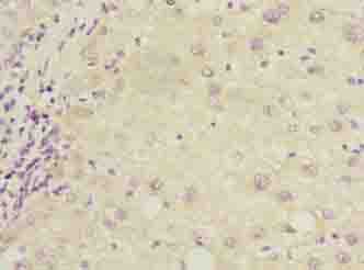 COX17 Antibody - Immunohistochemistry of paraffin-embedded human liver cancer using antibody at dilution of 1:100.
