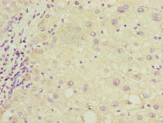 COX17 Antibody - Immunohistochemistry of paraffin-embedded human liver cancer using COX17 Antibody at dilution of 1:100
