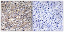 COX17 Antibody - Peptide - + Immunohistochemistry analysis of paraffin-embedded human liver carcinoma tissue using COX17 antibody.