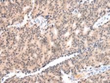 COX17 Antibody - Immunohistochemistry of paraffin-embedded Human prost at e cancer tissue  using COX17 Polyclonal Antibody at dilution of 1:55(×200)