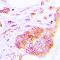 COX17 Antibody - Immunohistochemical analysis of COX17 staining in human lung cancer formalin fixed paraffin embedded tissue section. The section was pre-treated using heat mediated antigen retrieval with sodium citrate buffer (pH 6.0). The section was then incubated with the antibody at room temperature and detected using an HRP conjugated compact polymer system. DAB was used as the chromogen. The section was then counterstained with hematoxylin and mounted with DPX.