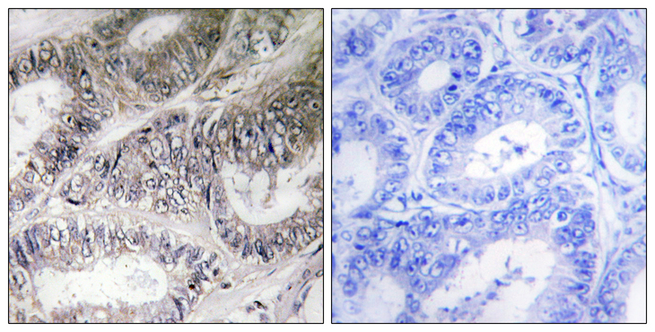 COX19 Antibody - Immunohistochemistry analysis of paraffin-embedded human colon carcinoma tissue, using COX19 Antibody. The picture on the right is blocked with the synthesized peptide.
