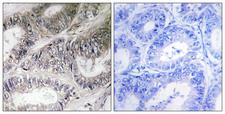 COX19 Antibody - Immunohistochemistry analysis of paraffin-embedded human colon carcinoma tissue, using COX19 Antibody. The picture on the right is blocked with the synthesized peptide.