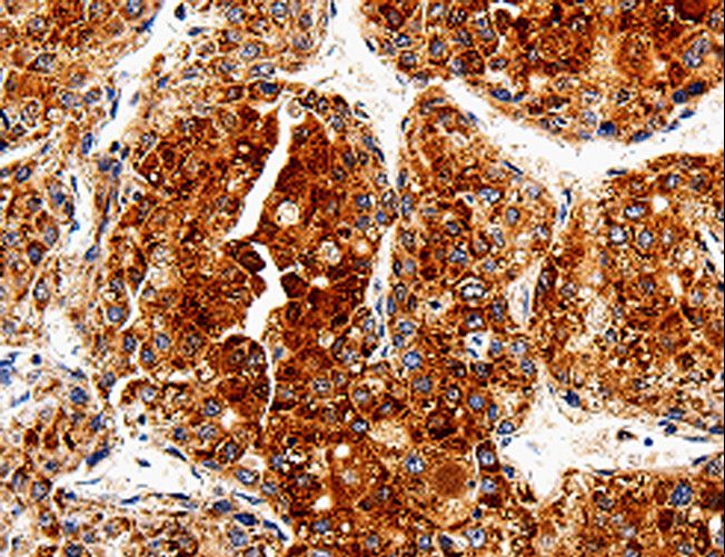 COX19 Antibody - Immunohistochemistry of paraffin-embedded Human liver cancer using COX19 Polyclonal Antibody at dilution of 1:50.