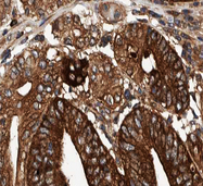 COX19 Antibody - 1:100 staining human Stomach carcinoma tissue by IHC-P. The tissue was formaldehyde fixed and a heat mediated antigen retrieval step in citrate buffer was performed. The tissue was then blocked and incubated with the antibody for 1.5 hours at 22°C. An HRP conjugated goat anti-rabbit antibody was used as the secondary.