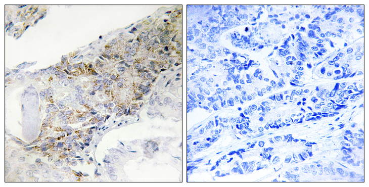 COX5B Antibody - Immunohistochemistry analysis of paraffin-embedded human breast carcinoma tissue, using COX5B Antibody. The picture on the right is blocked with the synthesized peptide.