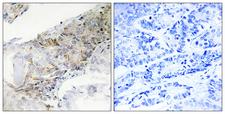 COX5B Antibody - Immunohistochemistry analysis of paraffin-embedded human breast carcinoma tissue, using COX5B Antibody. The picture on the right is blocked with the synthesized peptide.