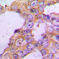 COX5B Antibody - Immunohistochemical analysis of COX5B staining in human lung cancer formalin fixed paraffin embedded tissue section. The section was pre-treated using heat mediated antigen retrieval with sodium citrate buffer (pH 6.0). The section was then incubated with the antibody at room temperature and detected using an HRP conjugated compact polymer system. DAB was used as the chromogen. The section was then counterstained with hematoxylin and mounted with DPX. w