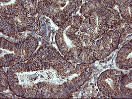 COX6C Antibody - IHC of paraffin-embedded Adenocarcinoma of Human endometrium tissue using anti-COX6C mouse monoclonal antibody. (Heat-induced epitope retrieval by 10mM citric buffer, pH6.0, 120°C for 3min).