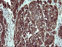 COX6C Antibody - IHC of paraffin-embedded Adenocarcinoma of Human colon tissue using anti-COX6C mouse monoclonal antibody. (Heat-induced epitope retrieval by 10mM citric buffer, pH6.0, 120°C for 3min).