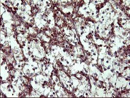 COX6C Antibody - IHC of paraffin-embedded Carcinoma of Human kidney tissue using anti-COX6C mouse monoclonal antibody. (Heat-induced epitope retrieval by 10mM citric buffer, pH6.0, 120°C for 3min).