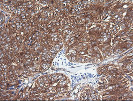 COX6C Antibody - IHC of paraffin-embedded Adenocarcinoma of Human ovary tissue using anti-COX6C mouse monoclonal antibody.