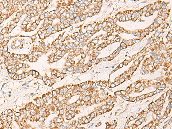 COX6C Antibody - Immunohistochemistry of paraffin-embedded Human liver cancer tissue  using COX6C Polyclonal Antibody at dilution of 1:25(×200)