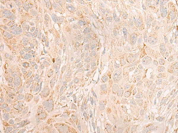 COX6C Antibody - Immunohistochemistry of paraffin-embedded Human esophagus cancer tissue  using COX6C Polyclonal Antibody at dilution of 1:25(×200)