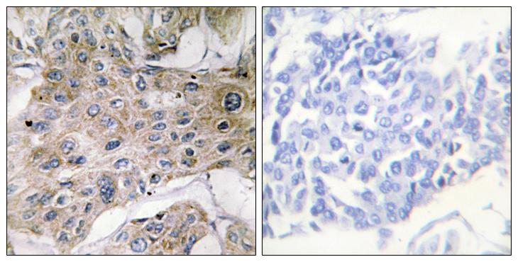 COX7A2 Antibody - Peptide - + Immunohistochemistry analysis of paraffin-embedded human breast carcinoma tissue using COX7S/A2 antibody.