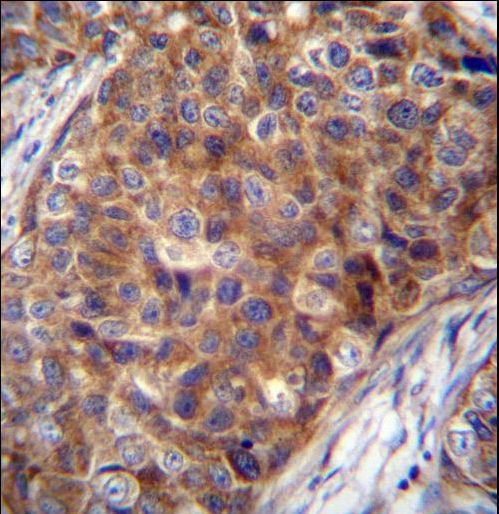 COX7A2L Antibody - COX7A2L Antibody immunohistochemistry of formalin-fixed and paraffin-embedded human breast carcinoma followed by peroxidase-conjugated secondary antibody and DAB staining.