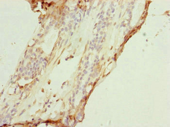COX7A2L Antibody - Immunohistochemistry of paraffin-embedded human breast cancer at dilution of 1:100