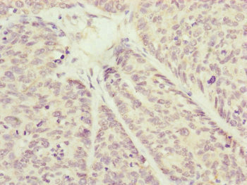 COX7A2L Antibody - Immunohistochemistry of paraffin-embedded human ovarian cancer at dilution of 1:100