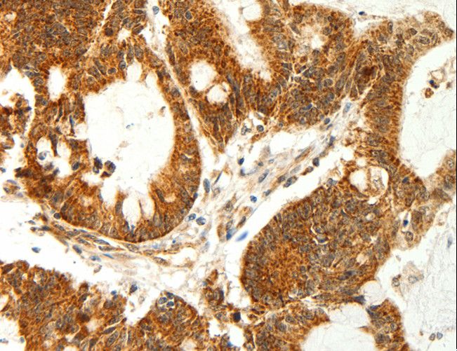 COX7B Antibody - Immunohistochemistry of paraffin-embedded Human colon cancer using COX7B Polyclonal Antibody at dilution of 1:60.