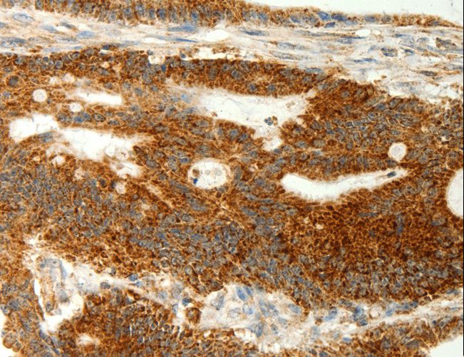 COX7B Antibody - Immunohistochemistry of paraffin-embedded Human colon cancer using COX7B Polyclonal Antibody at dilution of 1:70.