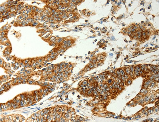 COX7B Antibody - Immunohistochemistry of paraffin-embedded Human gastric cancer using COX7B Polyclonal Antibody at dilution of 1:70.