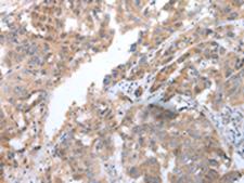 COX7C Antibody - Immunohistochemistry of paraffin-embedded Human breast cancer tissue  using COX7C Polyclonal Antibody at dilution of 1:40(×200)