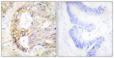 COXIV / COX4 Antibody - Immunohistochemistry analysis of paraffin-embedded human colon carcinoma tissue, using COX41 Antibody. The picture on the right is blocked with the synthesized peptide.
