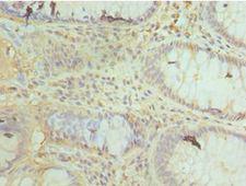 COXIV / COX4 Antibody - Immunohistochemistry of paraffin-embedded human colon cancer using antibody at 1:100 dilution.