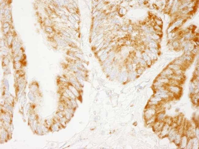COXIV / COX4 Antibody - Detection of Human COX4 by Immunohistochemistry. Sample: FFPE section of human lung carcinoma. Antibody: Affinity purified rabbit anti-COX4 used at a dilution of 1:200 (1 ug/ml). Detection: DAB.