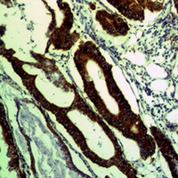 COXIV / COX4 Antibody - Immunohistochemical analysis of COX4-1 staining in human colon cancer formalin fixed paraffin embedded tissue section. The section was pre-treated using heat mediated antigen retrieval with sodium citrate buffer (pH 6.0). The section was then incubated with the antibody at room temperature and detected using an HRP conjugated compact polymer system. DAB was used as the chromogen. The section was then counterstained with hematoxylin and mounted with DPX.