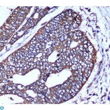 COXIV / COX4 Antibody - Immunohistochemical analysis of paraffin-embedded human colorectal carcinoma with COX IV Mouse mAb (4D11-B3-E8,1:50 diluted),showing cytoplasm localization.A high pressure mediated antigen retrieval step was performed in citrate buffer (pH6.0).