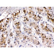 CP / Ceruloplasmin Antibody - Ceruloplasmin was detected in paraffin-embedded sections of human liver cancer tissues using rabbit anti- Ceruloplasmin Antigen Affinity purified polyclonal antibody at 1 ug/mL. The immunohistochemical section was developed using SABC method.