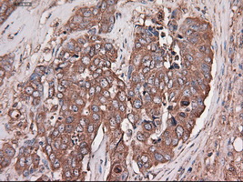 CPA1 / Carboxypeptidase A Antibody - IHC of paraffin-embedded Adenocarcinoma of breast using anti-CPA1 mouse monoclonal antibody.